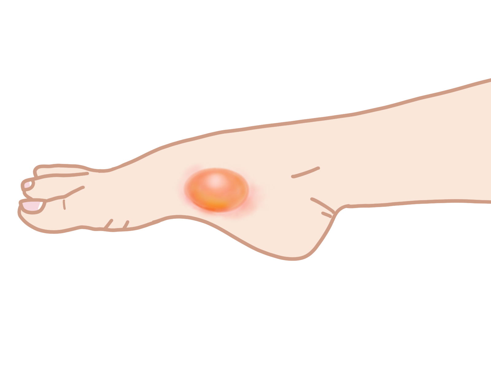 類天疱瘡 | 自由になりたい薬剤師の学習ノート