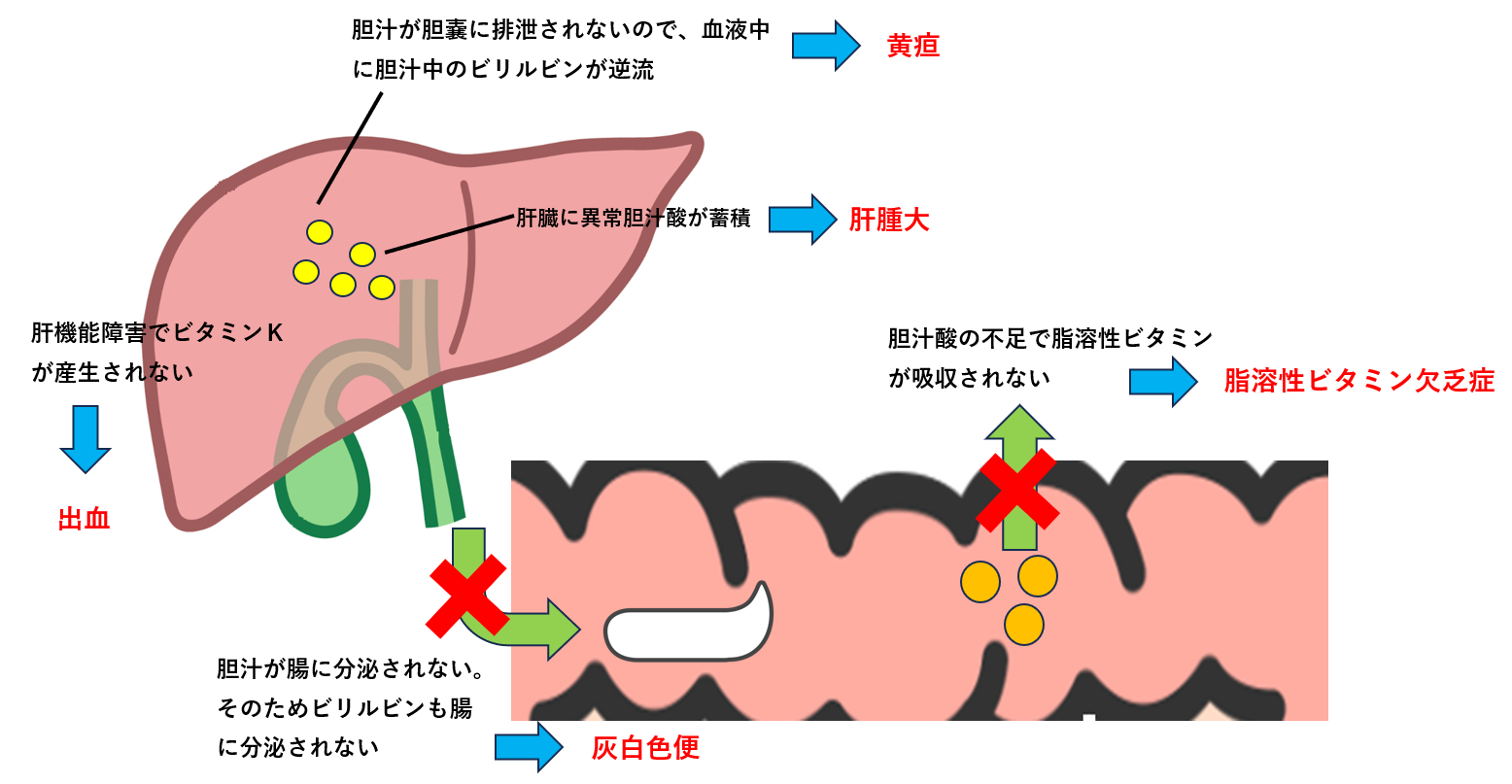 オファコルカプセル 先天性胆汁酸代謝異常 | 自由になりたい薬剤師の学習ノート